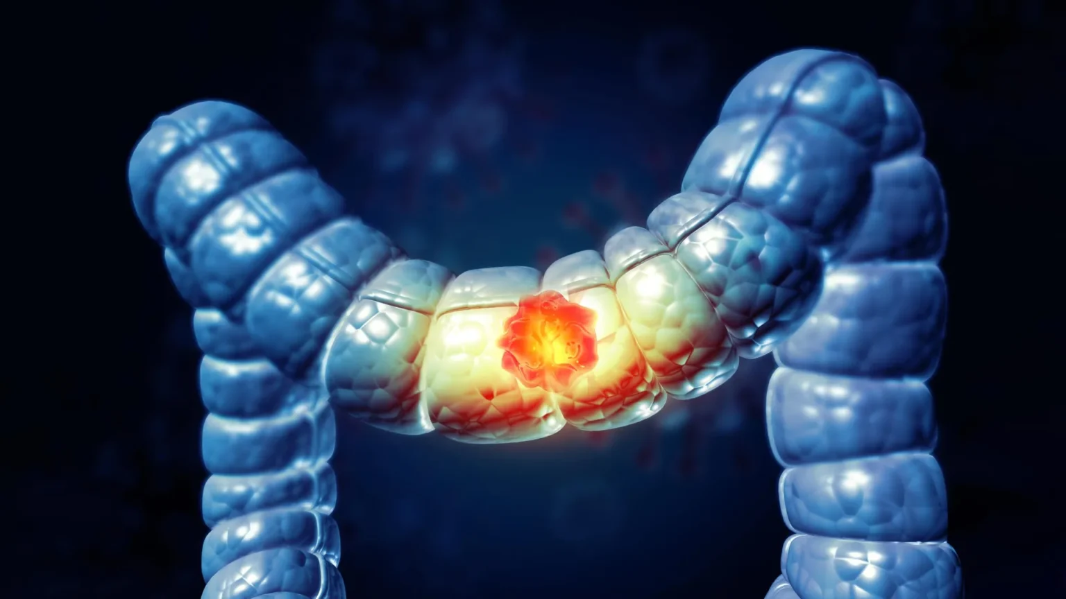 Most Americans don’t know this food increases the risk of colon cancer