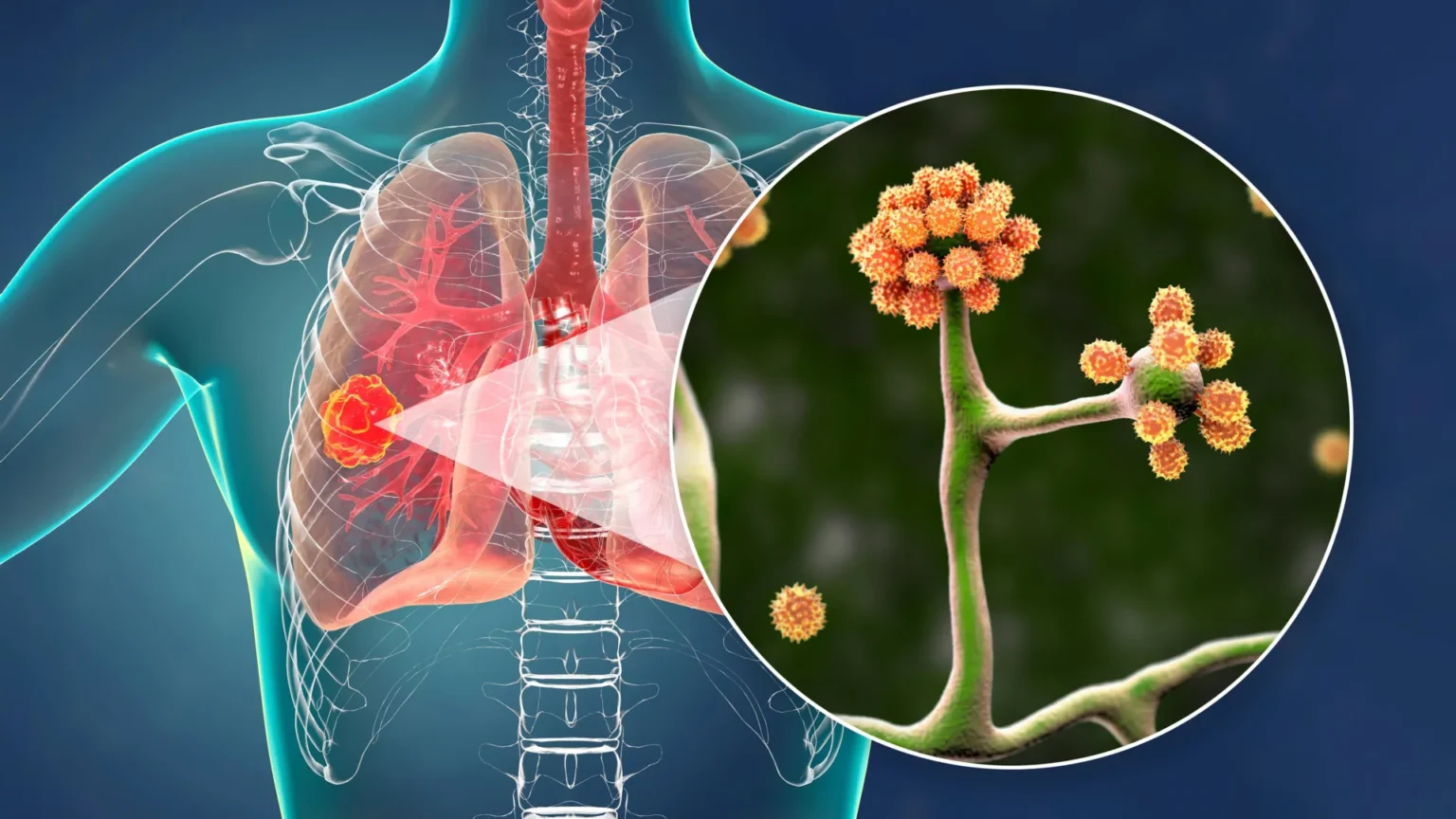This simple blood protein could stop deadly black fungus