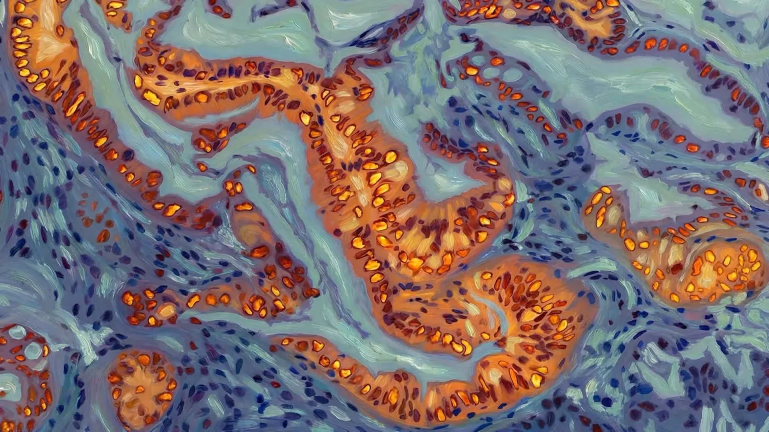 Scientists discover gene switch that makes pancreatic cancer resistant to chemotherapy