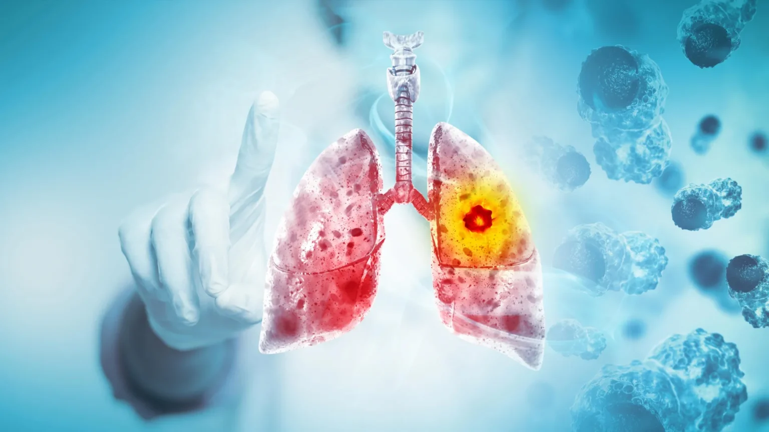Scientists discover why this deadly lung cancer keeps coming back