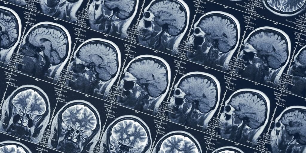 Brain scan reveals how woman spontaneously enters psychedelic trance state without drugs Brain scan reveals how woman spontaneously enters psychedelic trance state without drugs