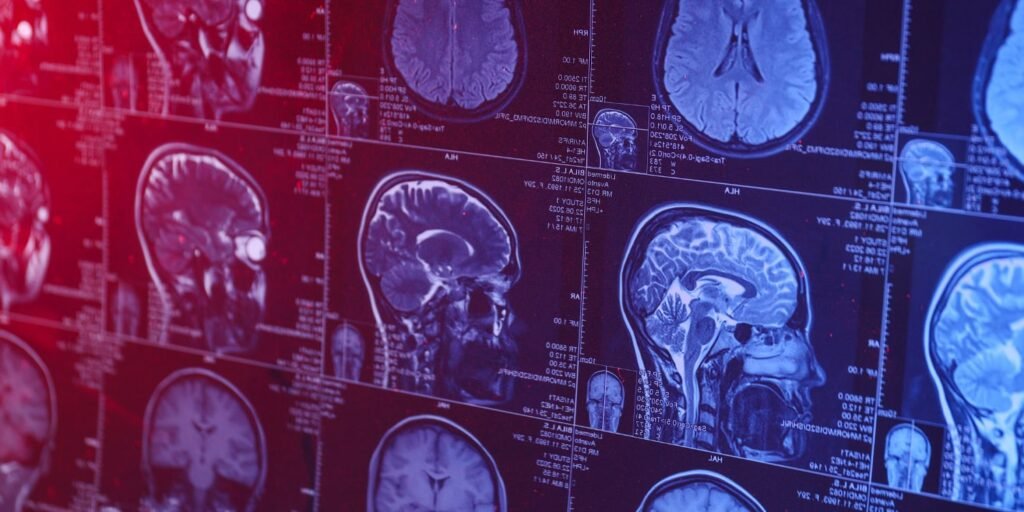 Decreased gray matter and changes in brain connectivity linked to problematic smartphone use