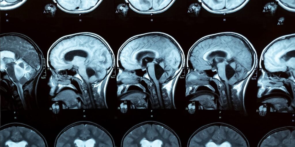 Everyday infections, not vaccines, are associated with increased risk of childhood stroke