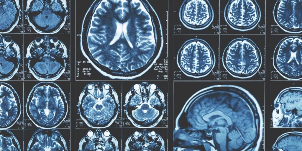 Surge in brain-attacking autoantibodies linked to early coronavirus pandemic