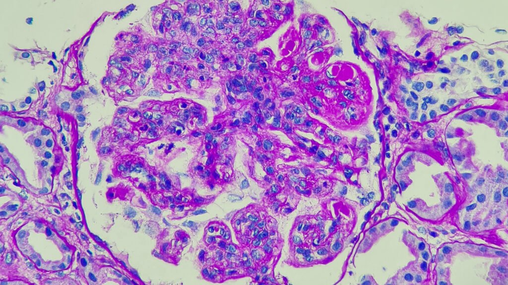 Successful CAR-T therapy revitalizes autoimmune field Successful CAR-T therapy revitalizes autoimmune field