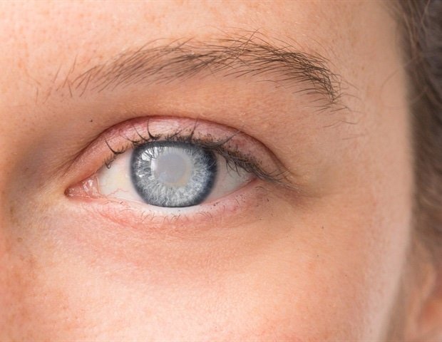 MMount Sinai Ophthalmologists Unveil Revolutionary Eye Fluid Monitoring Tool MMount Sinai Ophthalmologists Unveil Revolutionary Eye Fluid Monitoring Tool