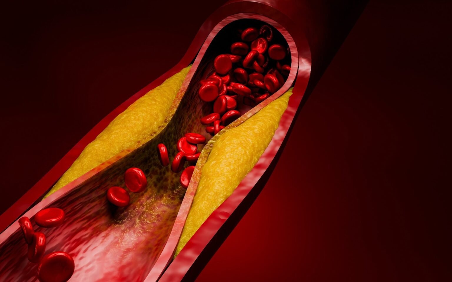 Evolocumab trial could change the way doctors treat high-risk cholesterol patients