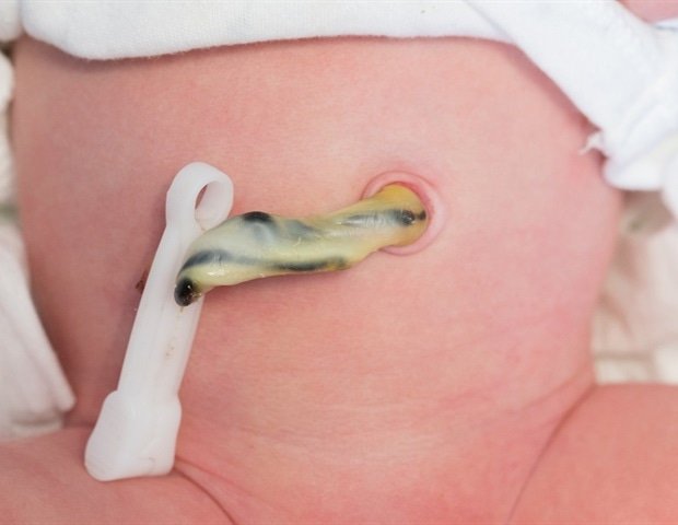 New umbilical cord blood approach improves survival for blood disease patients