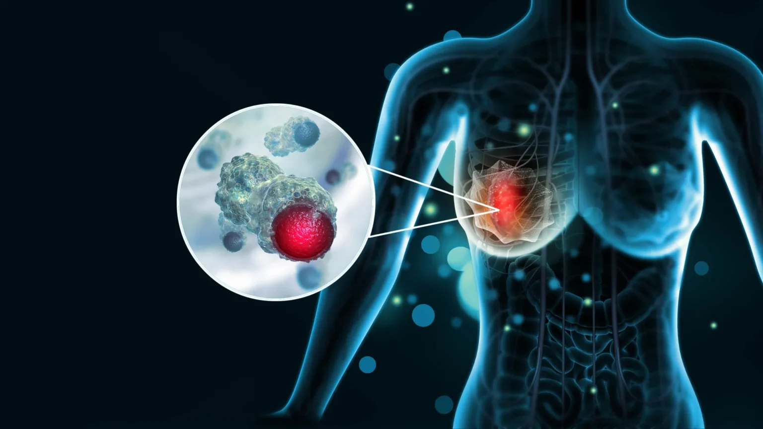How advanced breast cancer disables the immune system