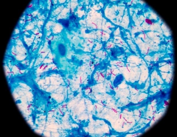 Common tuberculosis screening test may predict long-term survival of patients