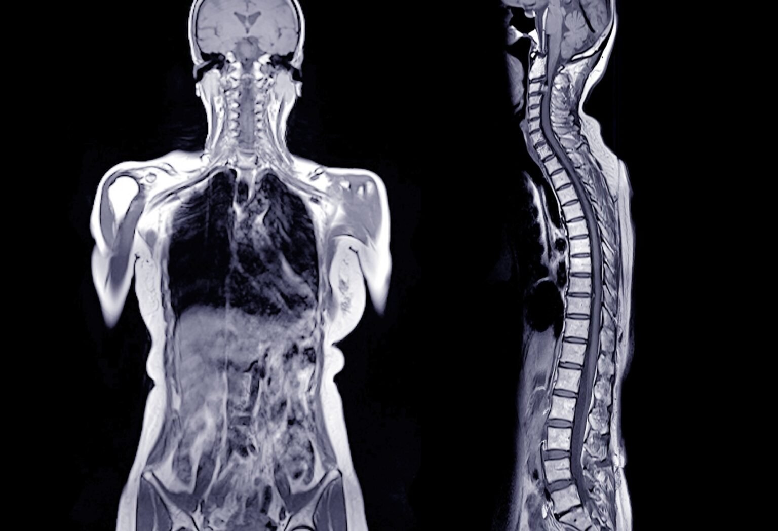 AI-powered MRI scans predict diabetes and heart disease risk