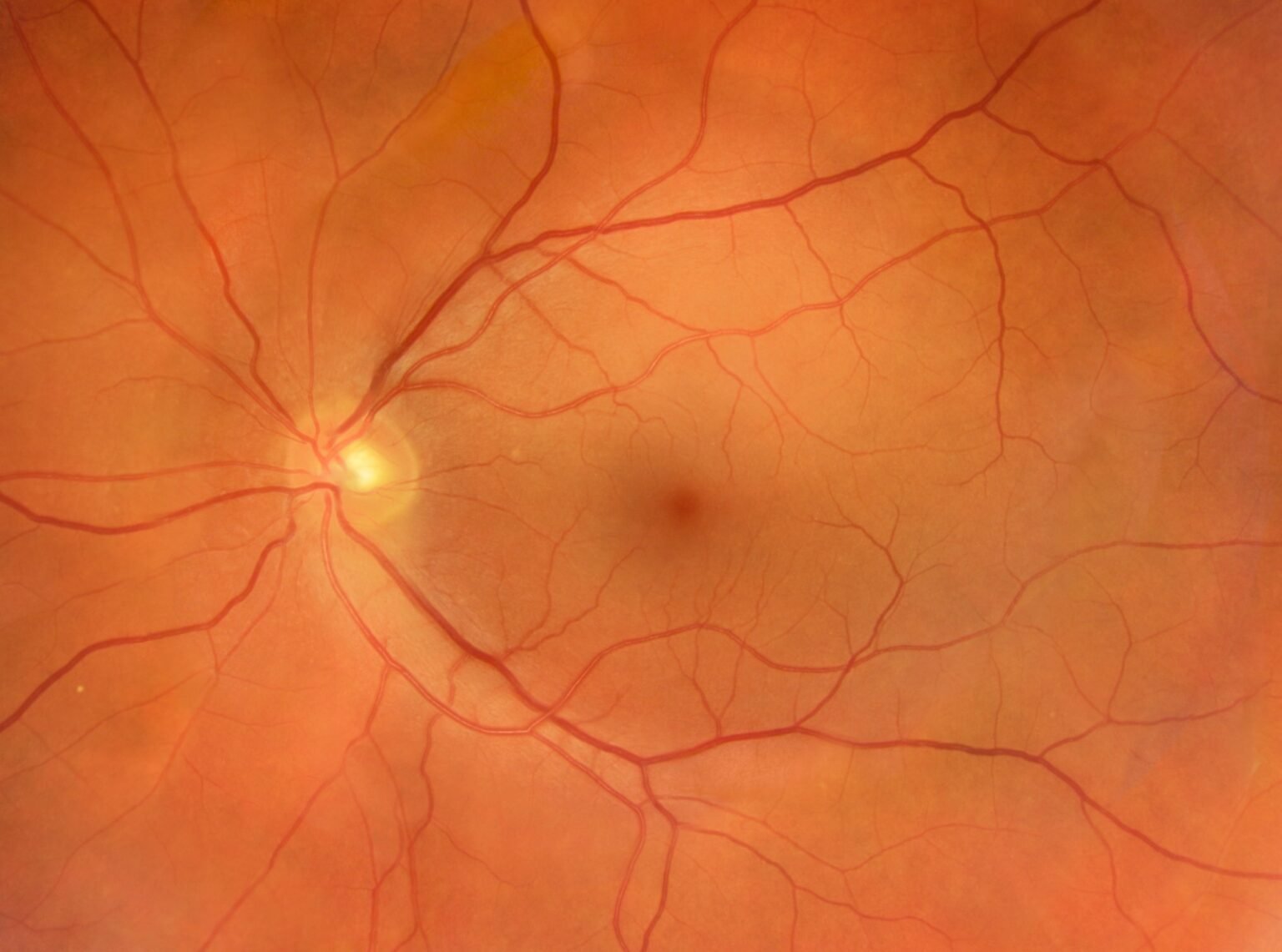 AI eye scan reveals who may be at higher risk of osteoporosis