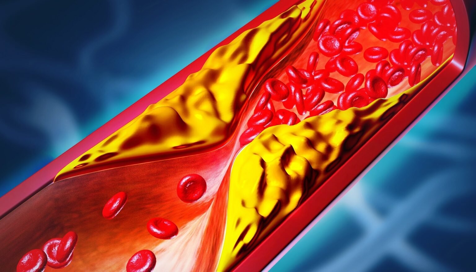 One-time gene editing reduces LDL cholesterol in early hypercholesterolemia trial