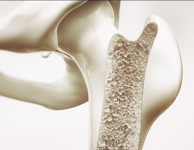 Clinical trial questions long-held beliefs about brittle bone disease treatment