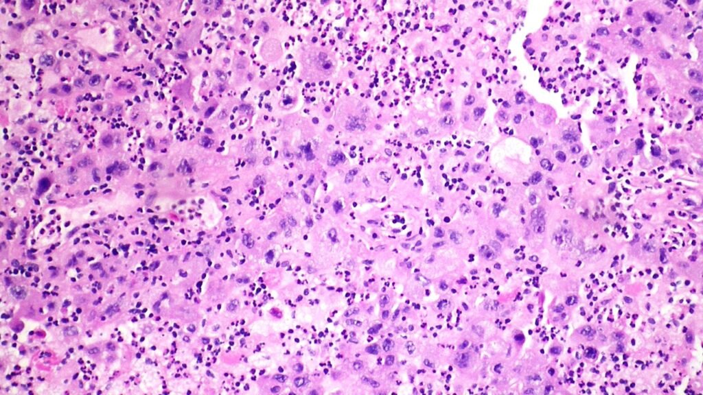 Merck Cologne’s lung cancer drug reduces risk of tumor progression by 65%