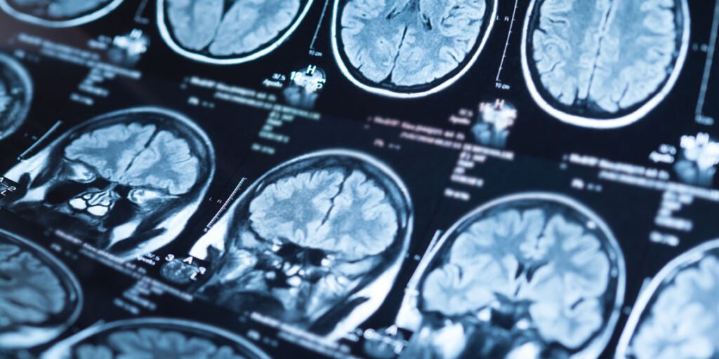 Anatomical brain mapping distinguishes structural deviations in violent psychosis from non-violent schizophrenia