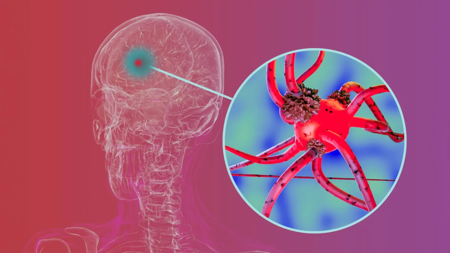 Researchers block key protein that helps Parkinson’s disease spread to the brain