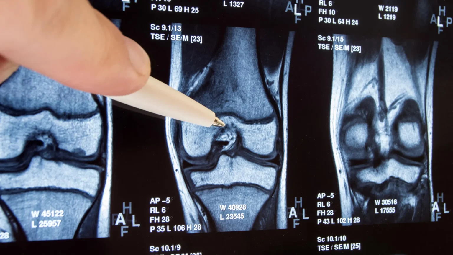Common knee surgery turns out to be ineffective and could make matters worse