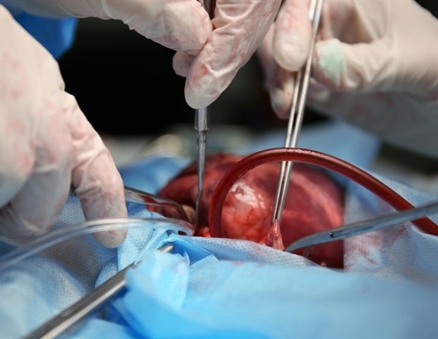 A patient’s intuition led to emergency open-heart surgery at NYU Langone Hospital in Brooklyn. A patient’s intuition led to emergency open-heart surgery at NYU Langone Hospital in Brooklyn.