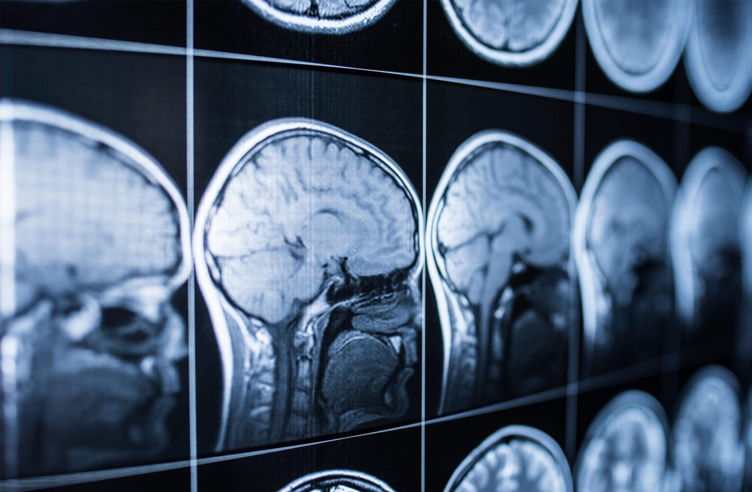 High intake of ultra-processed foods is associated with increased risk of dementia in older people