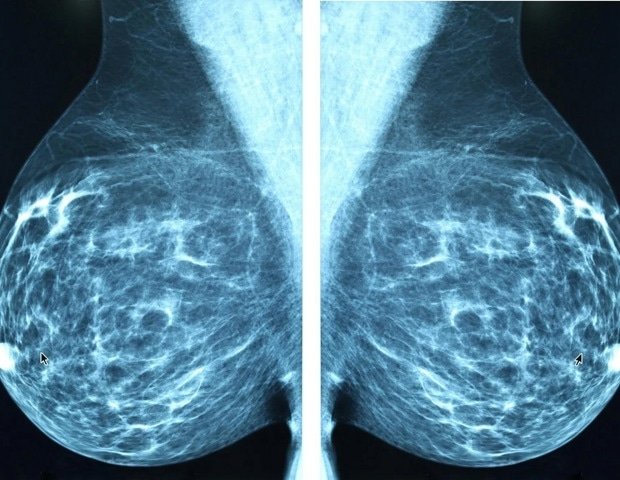 Brain-targeted estrogen reduces breast cancer treatment side effects Brain-targeted estrogen reduces breast cancer treatment side effects