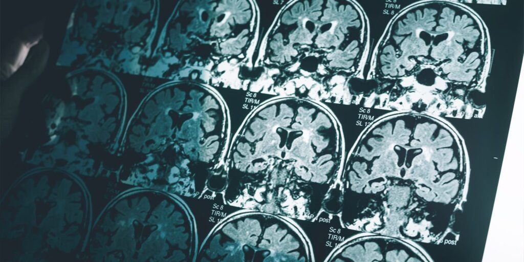 Psychopathic traits are linked to thinner cerebral cortex in men Psychopathic traits are linked to thinner cerebral cortex in men