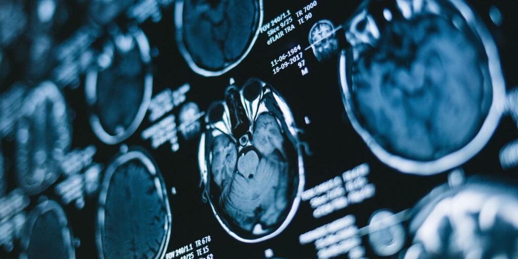 Genetic risk for Alzheimer’s disease may depend on sleep quality