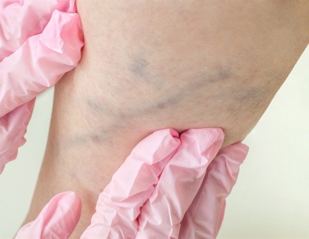 New PET radiotracer showed high accuracy in detecting blood clots in legs and lungs