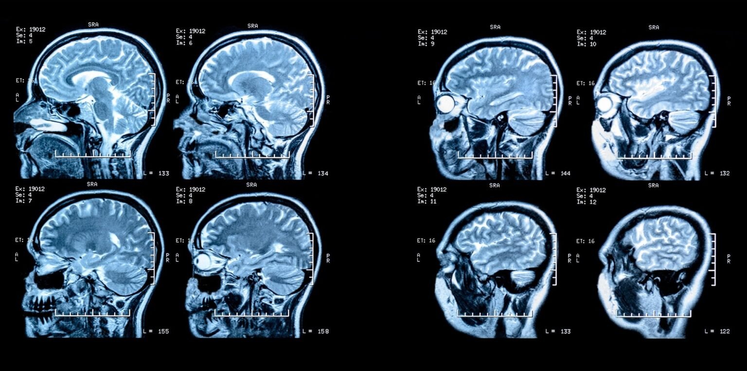 High-dose ocrelizumab depletes more B cells but does not slow MS progression
