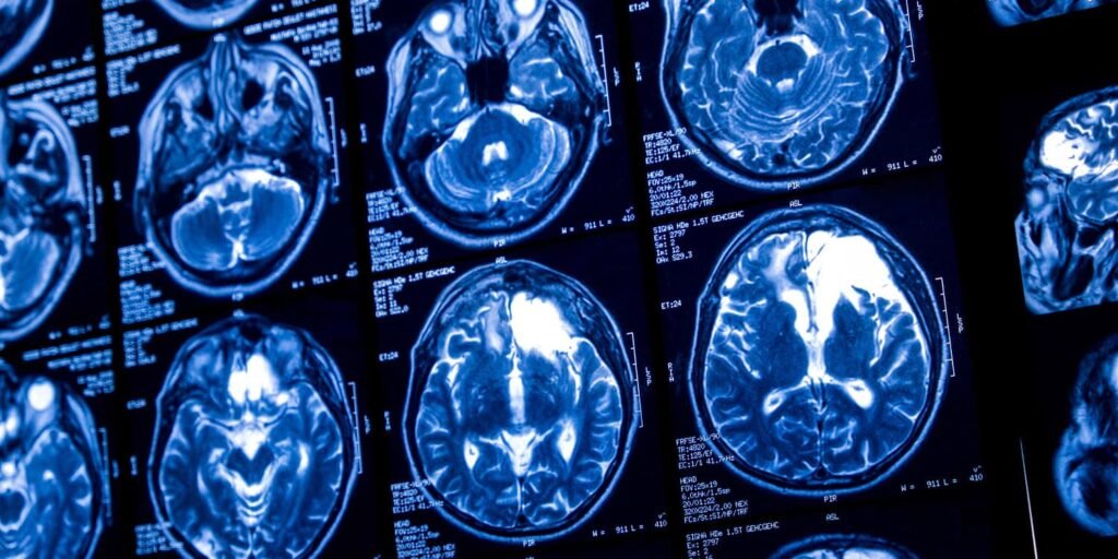 Growing up in an underprivileged area can lead to faster brain maturation Growing up in an underprivileged area can lead to faster brain maturation