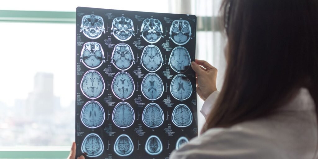 Brain scans link tissue shrinkage and aggression in schizophrenia Brain scans link tissue shrinkage and aggression in schizophrenia