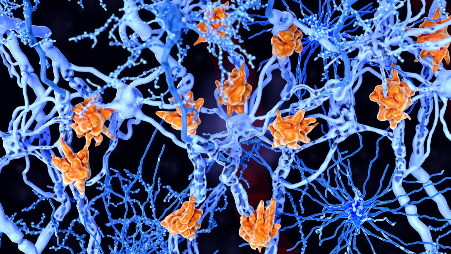These fat-filled brain cells may be worsening multiple sclerosis