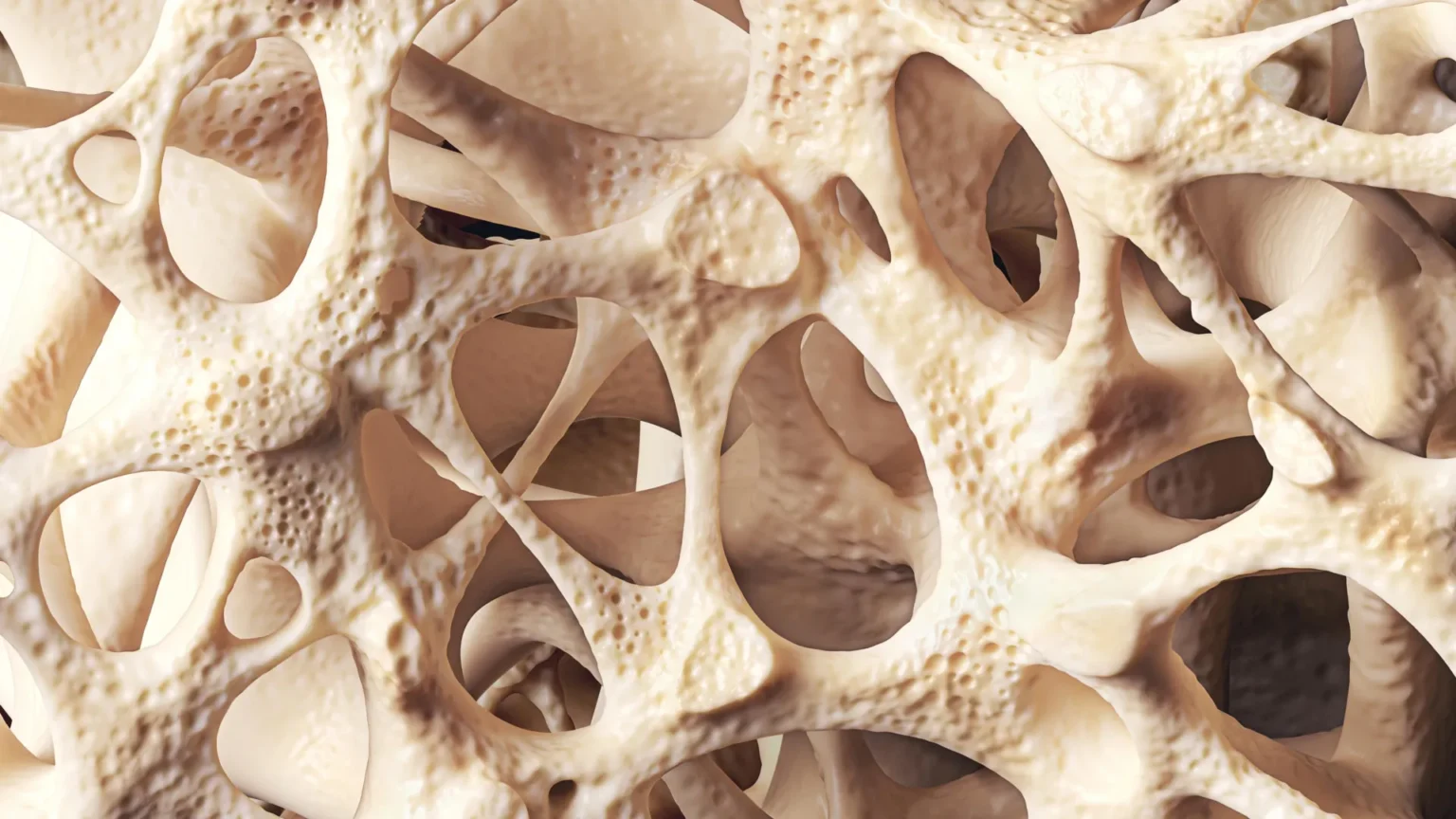 Osteopenia quietly weakens the bones of millions of people