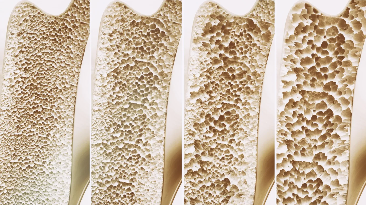 Millions of people take calcium and vitamin D to strengthen their bones. Extensive reviews bring little benefit