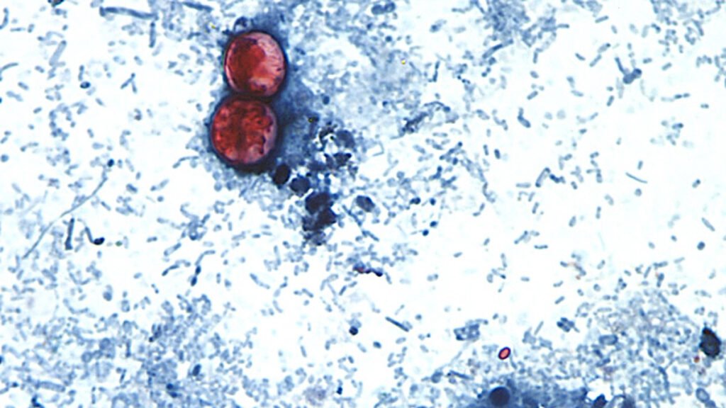 More than 1,000 cases of Cyclospora have now been reported in 29 states. More than 1,000 cases of Cyclospora have now been reported in 29 states.