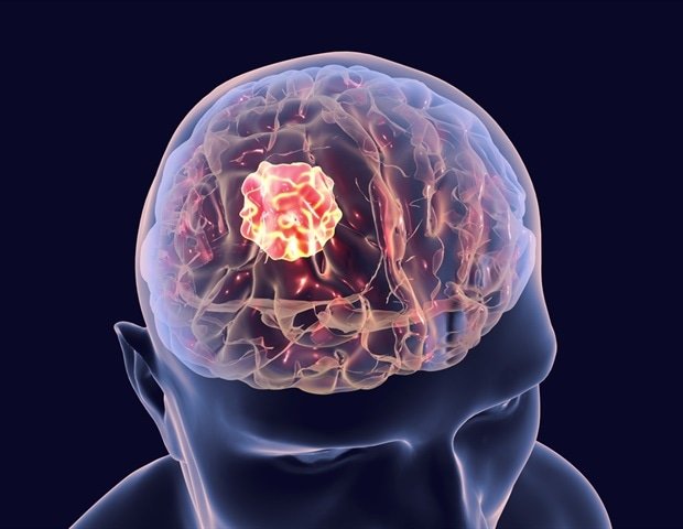 UVA researchers develop new experimental approach to target glioblastoma