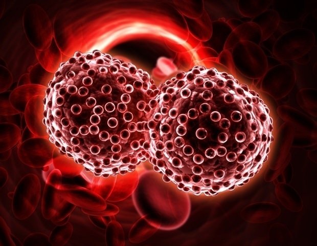 New AI score enhances monitoring of myelodysplastic tumors New AI score enhances monitoring of myelodysplastic tumors