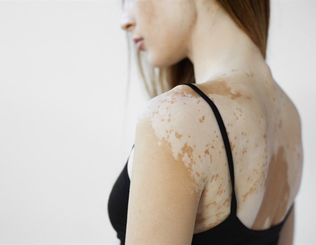 Dormant melanocytes found in vitiligo offer hope for future repigmentation therapies
