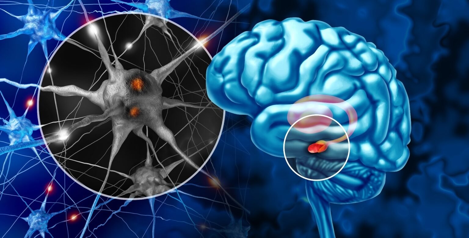Short sleep and poor sleep quality track risk of Parkinson’s disease