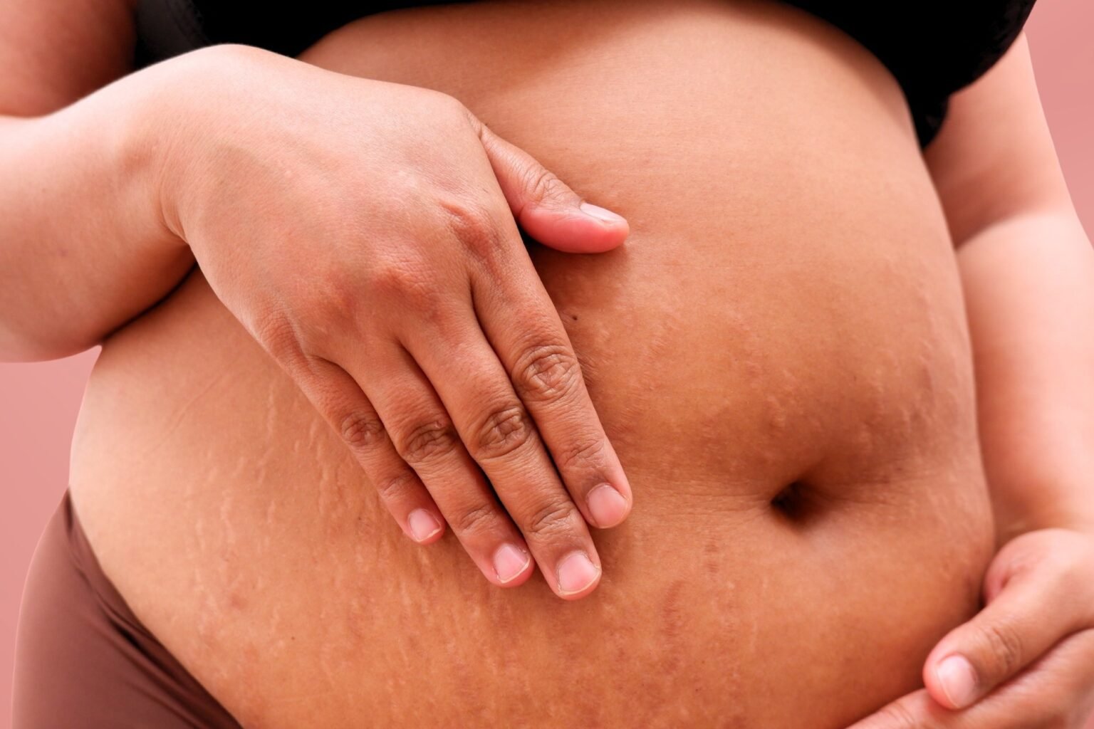 GLP-1 exposure during pregnancy does not clearly increase risk of major birth defects
