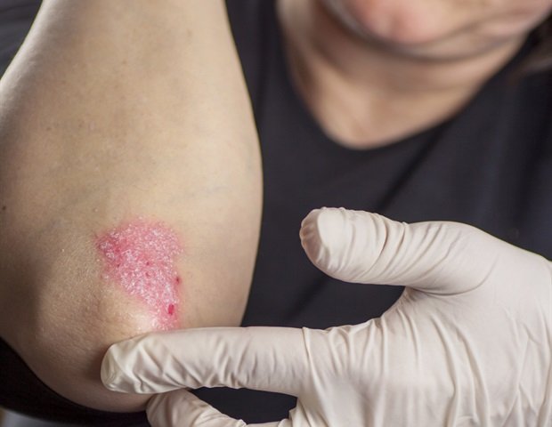 Biohub researchers use artificial intelligence to discover new psoriasis targets Biohub researchers use artificial intelligence to discover new psoriasis targets