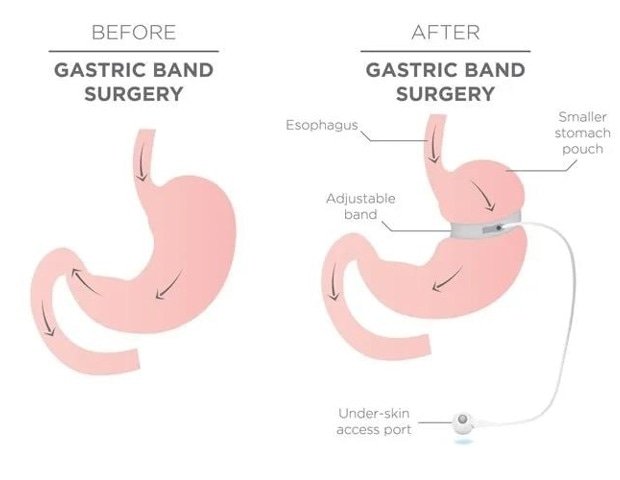 Bariatric surgery is safe and effective for obese youth and young adults Bariatric surgery is safe and effective for obese youth and young adults