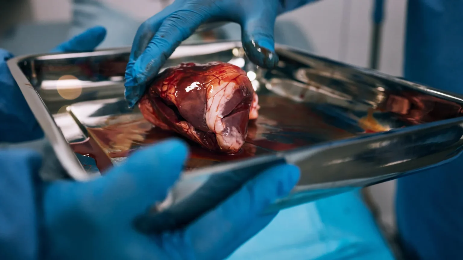 Almost half of kidney transplant patients never even start their kidney transplant.