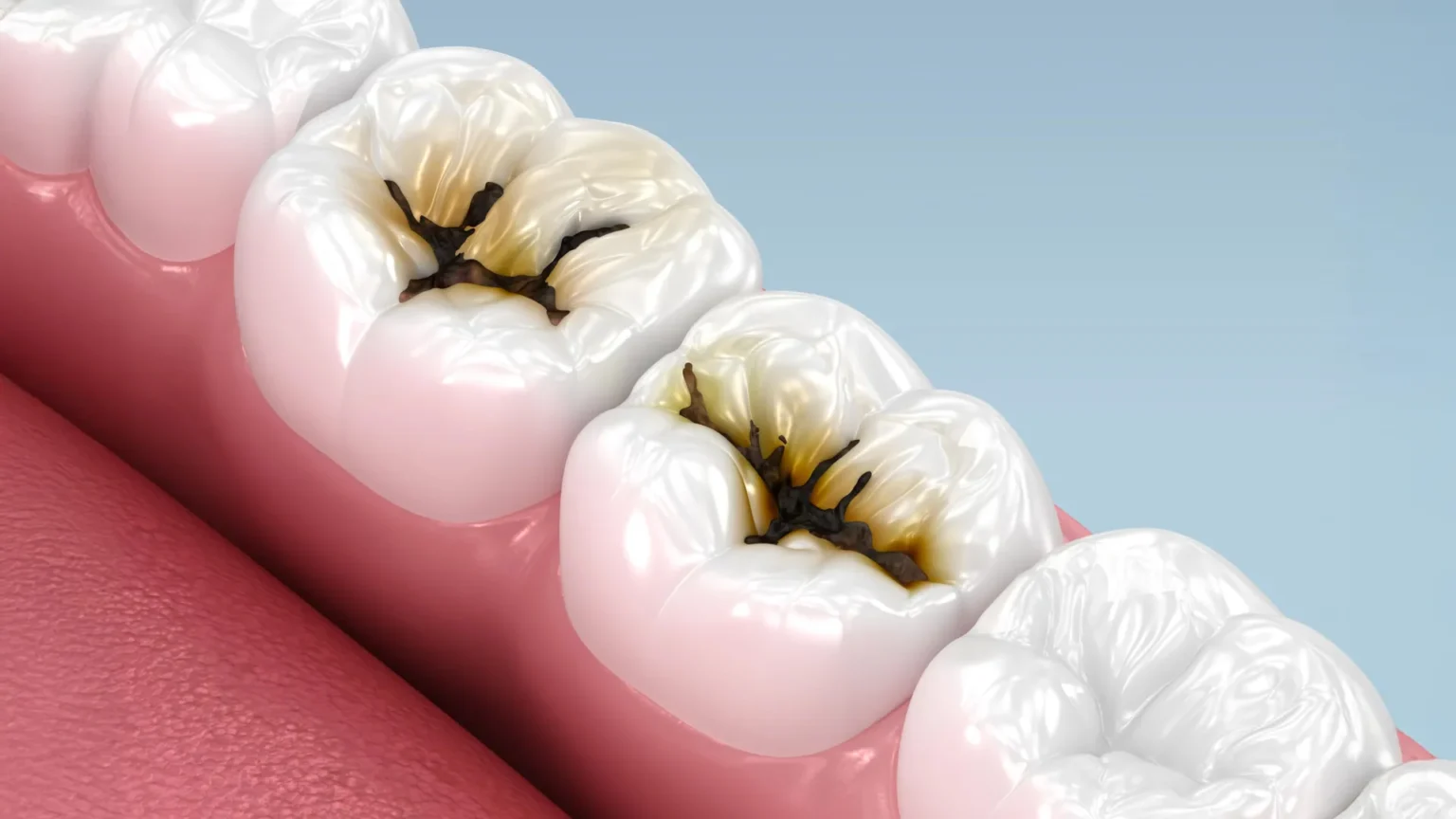Scientists discover easy way to stop cavities without drilling holes Scientists discover easy way to stop cavities without drilling holes