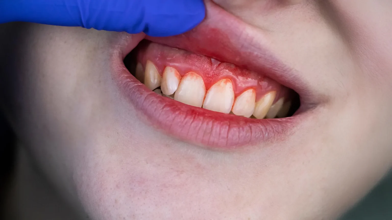 Scientists discover hidden heart valve risks associated with periodontal disease Scientists discover hidden heart valve risks associated with periodontal disease