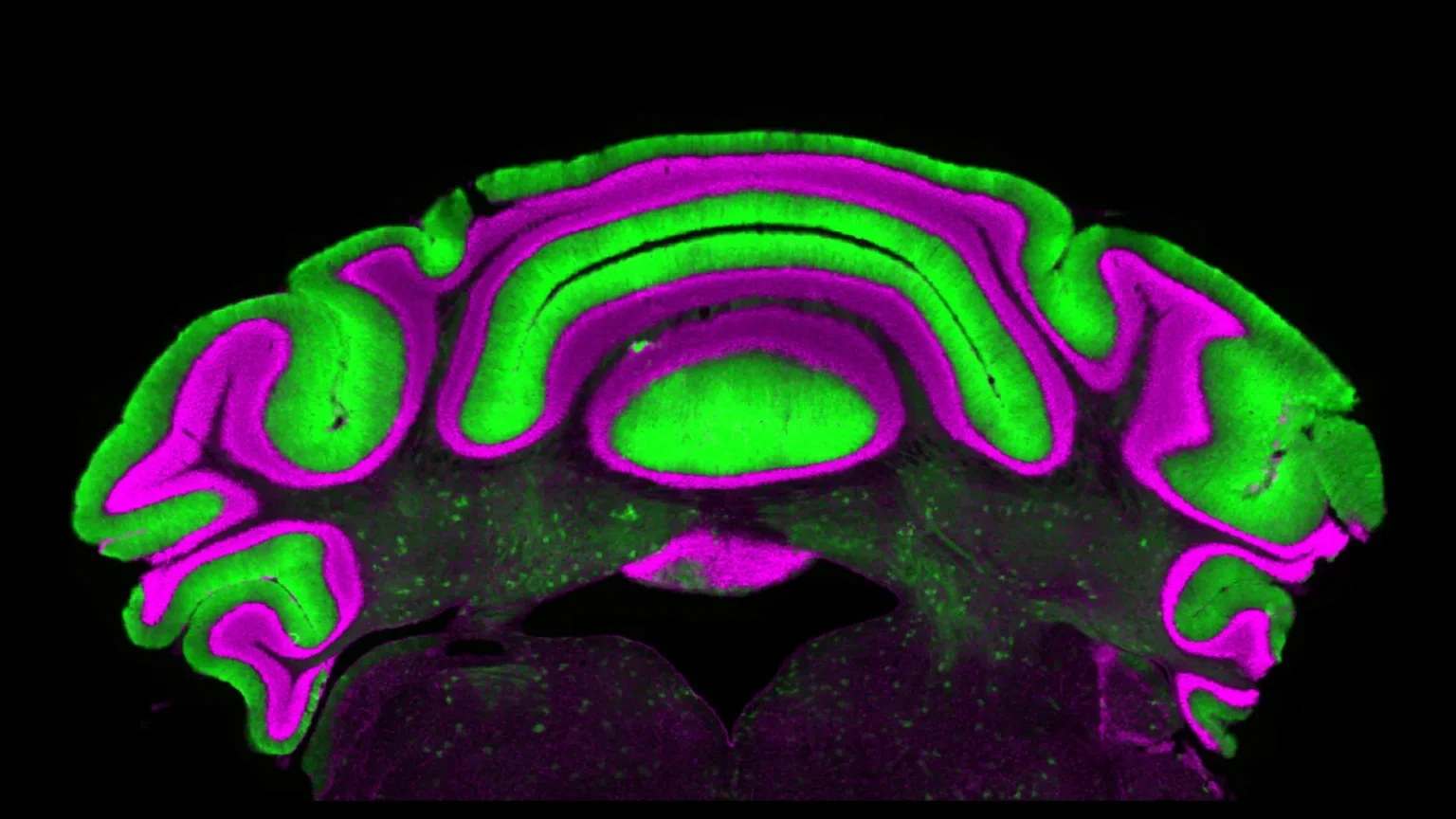 Surprising brain discovery forces scientists to rethink movement disorders